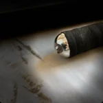 BOGENSANIERUNGSPACKER – Bild 2